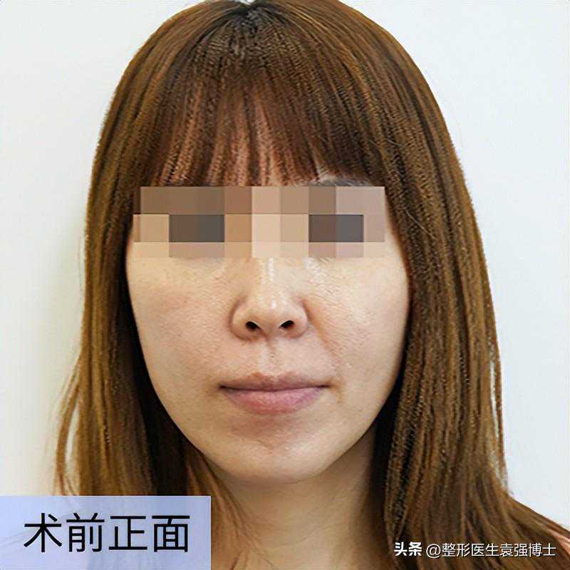 5小时10分“全脸拉皮”，43岁女士大拉皮手术过程，真实细节分享