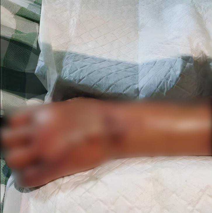 广东老人洗虾手指被刺，被迫截肢保命，为啥海鲜扎一下这么要命？